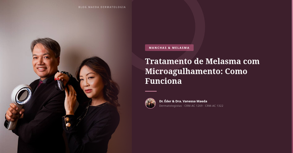 Tratamento de Melasma com Microagulhamento: Como Funciona